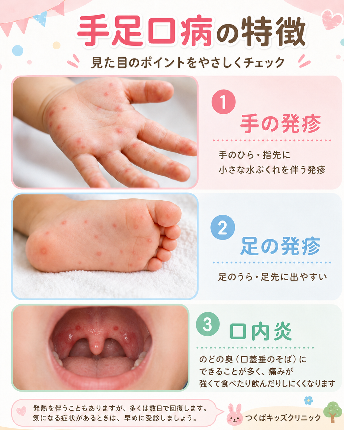 手足口病の症状を保護者向けに説明するやさしいイメージ画像